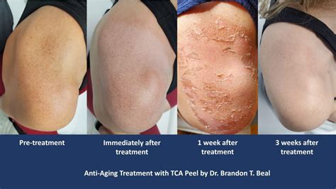 Chemical Peel Jacksonville – Chemical Peel for Acne Scars