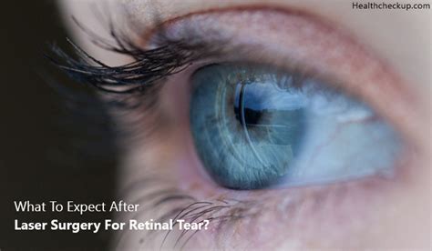 What To Expect After Laser Surgery For Retinal Tear by Dr. Himanshi