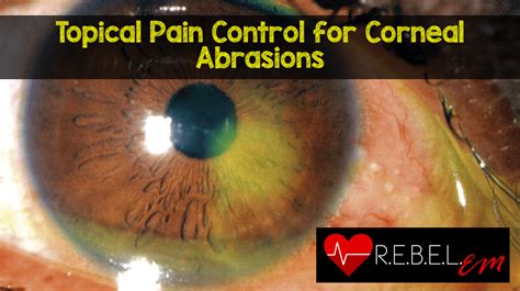 Topical Pain Control for Corneal Abrasions – MED-TAC International Corp.