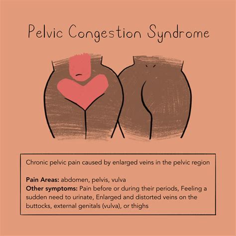 Pelvic Congestion Syndrome – Momotaro Apotheca