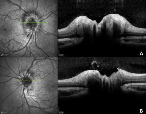 Differentiating Mild Papilledema and Buried Optic Nerve Head Drusen Using Spectral Domain ...