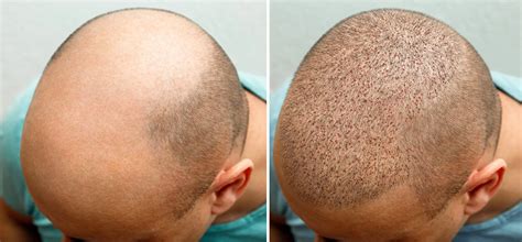 FUE Hair Transplant Before and After Process