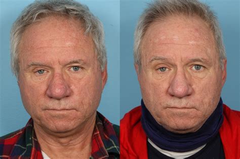 Rhinophyma Treatment | Plastic Surgery Chicago,IL |Dr. Sidle