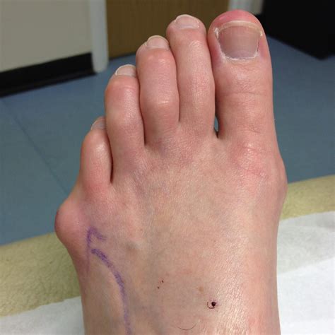 Bunion Surgery Leeds, | Yorkshire Foot HospitalYorkshire Foot Hospital