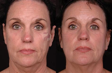 Thermage® Before and After Pictures Case 12 | Plano, Frisco, Dallas ...