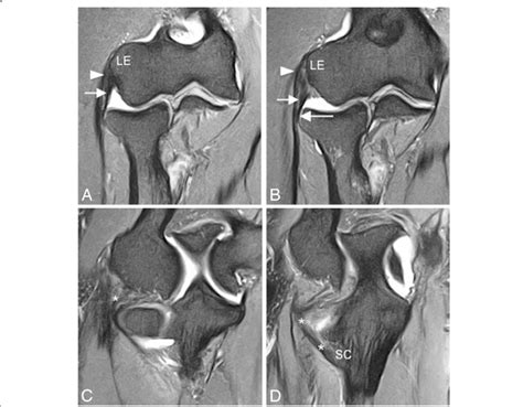 Consecutive coronal FS PD-weighted MRI (a-d) showing the intact lateral... | Download Scientific ...