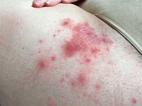 Red Rash On Upper Legs | Images and Photos finder