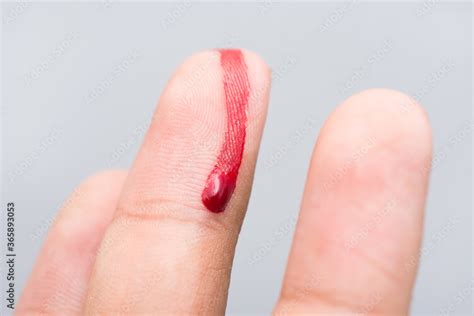 Finger Cut