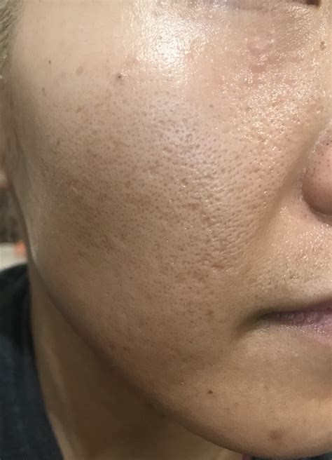 [Skin Concerns] 30F still with acne, atrophic scar treatment and mental health : SkincareAddiction