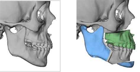 Maxillary Bone Contouring after LeFort I Osteotomy - Explore Plastic Surgery