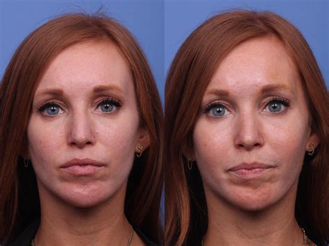 Cheek Implant Before and After Photo Gallery | Scottsdale, AZ | Hobgood Facial Plastic Surgery ...