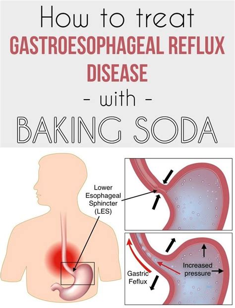 How to treat gastroesophageal reflux disease with baking soda ...