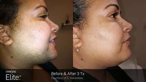 laser hair removal for dark skin uk - Maribeth Courtney