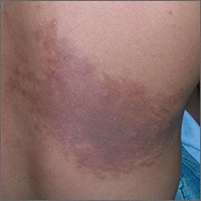 Enlarging dark patch on back | MDedge Family Medicine