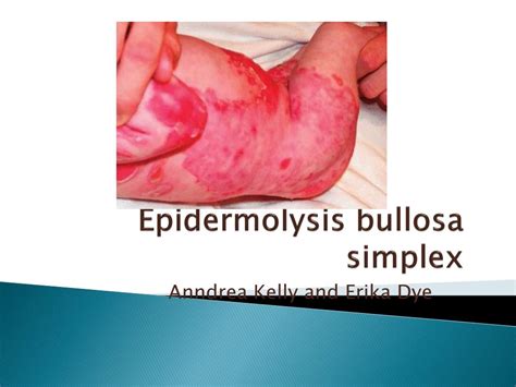 PPT - Epidermolysis bullosa simplex PowerPoint Presentation, free ...