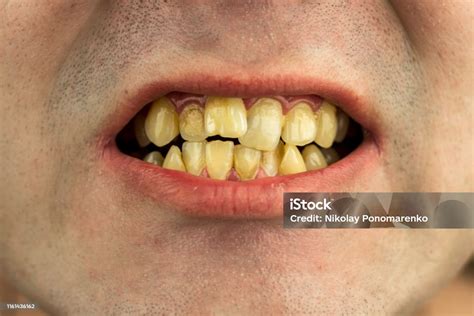 Crooked Dirty Smokers Teeth With A Wrong Bite Closeup Stock Photo - Download Image Now - iStock
