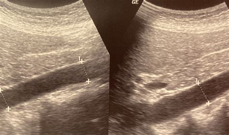 Ultrasound Imaging of the Abdominal Aorta: A Comprehensive Review