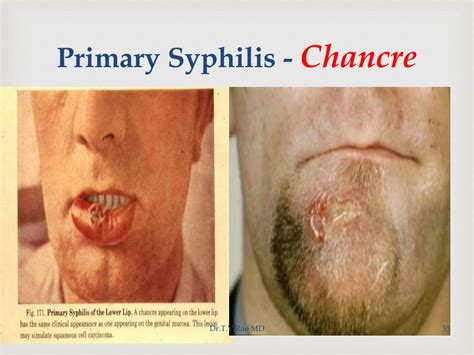 PPT - SYPHILIS basics PowerPoint Presentation, free download - ID:1890319