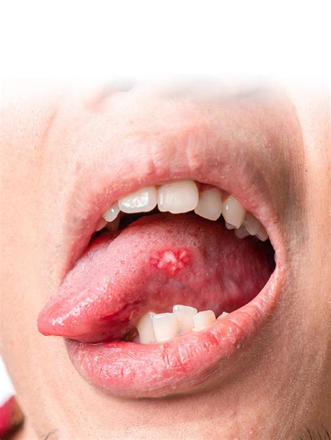 Blisters On Back Of Throat And Tongue Sale | www.cooksrecipes.com