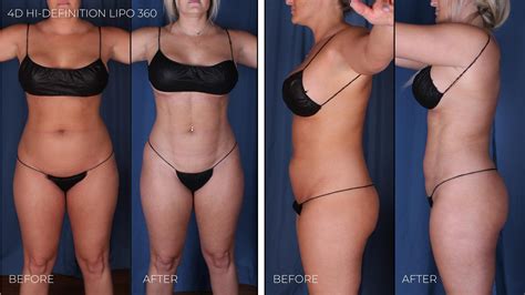 Liposuction Cost Omaha, NE - Omaha Liposuction by Imagen