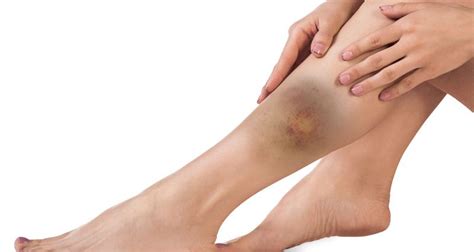 Calf Contusion - Symptoms, Causes, Treatment & Rehabiltiation