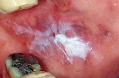 [PDF] Oral Lichenoid Contact Lesions to Mercury and Dental Amalgam—A Review | Semantic Scholar