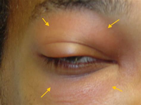 Preseptal Cellulitis Vs Orbital Cellulitis