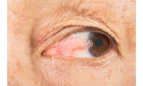 Do pterygiums and corneal scars prevent laser eye surgery? - We Fix Eyes