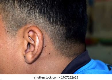 115 Birthmark on ear Images, Stock Photos & Vectors | Shutterstock