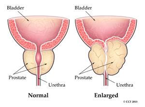 Benign Prostatic Enlargement/Hyperplasia (BPE/BPH) – Medisafepharma