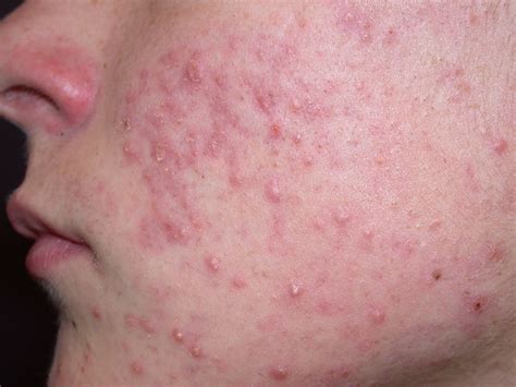 Facial Rashes: What’s the Diagnosis?