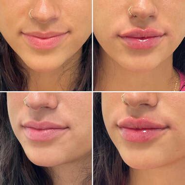 Understanding the Risks and Benefits of Lip Fillers – Macmillan Education Bookstore