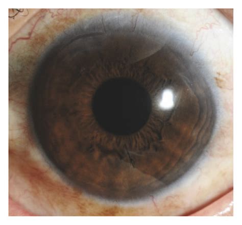 Patient 1 with iris posterior synechiae and corneal suture. (a ...