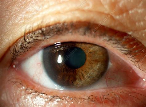 Iris Nevus - Stock Image - C027/2022 - Science Photo Library