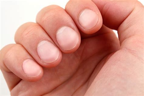 Kidney Disease Symptoms On Nails at Danielle Miller blog