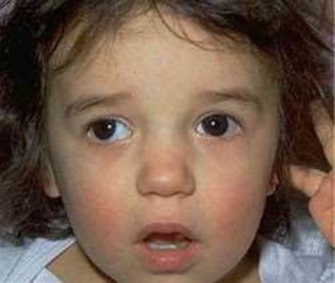 Exotropia - Children's Eye Foundation | AAPOS