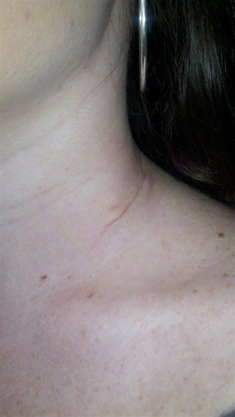 Adventures With My Enemy Melanoma: Updated Scar Pictures!