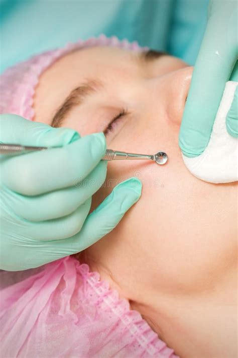 Blackhead Extraction In Ear