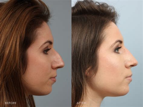 Nose Tip Reshaping Rhinoplasty Surgery | Williams Center Williams Center