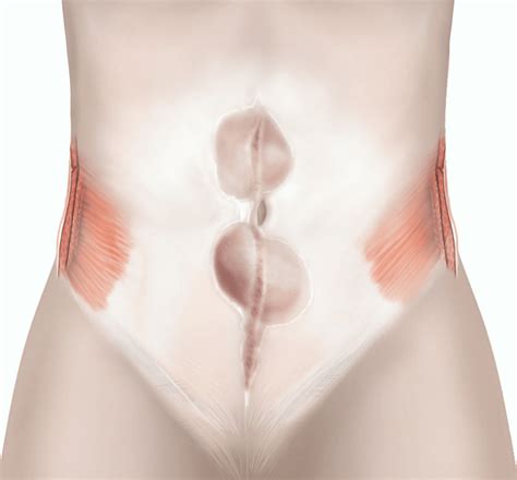 Open incisional hernia repair | healthdirect