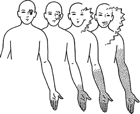 Typical-presentation-of-visual-aura-symptoms-associated-with-the-migraine-with-aura | teesneuro.org