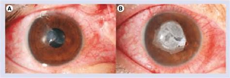 Partial Thickness Corneal Laceration