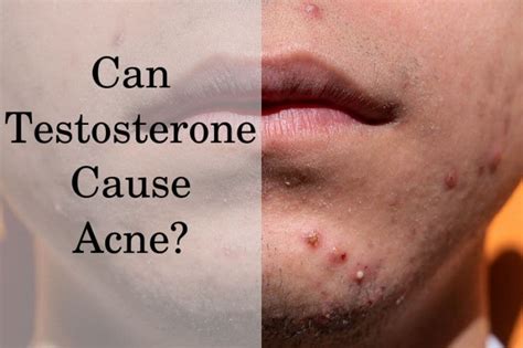 Is Testosterone a Cause of Your Acne? - HRTGuru