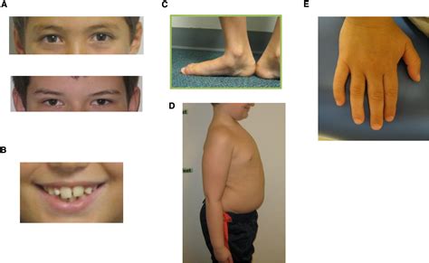 47,XYY Syndrome: Clinical Phenotype and Timing of Ascertainment - The ...