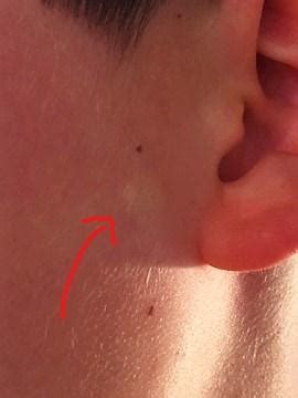 Son has a small cyst growing in front of his ear - any tips for how ...