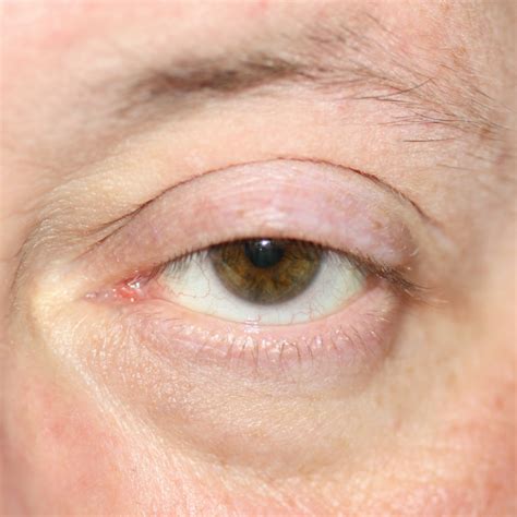 Droopy Eyelid (ptosis): Causes, Risk Factors, And Treatment, 51% OFF