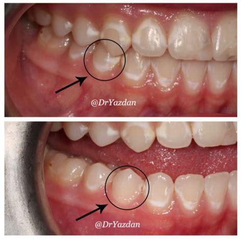 How To Prevent White Spots On Teeth - Rowwhole3