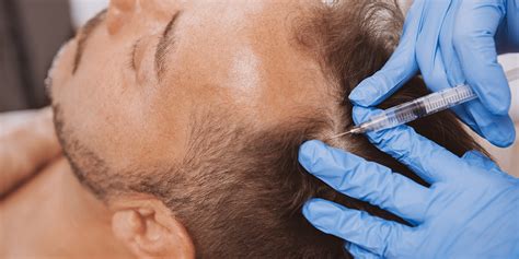 PRP For Hair Loss: How to Treat Hair Loss Long-Term - The Derm | Dermatologists in Cook County, IL