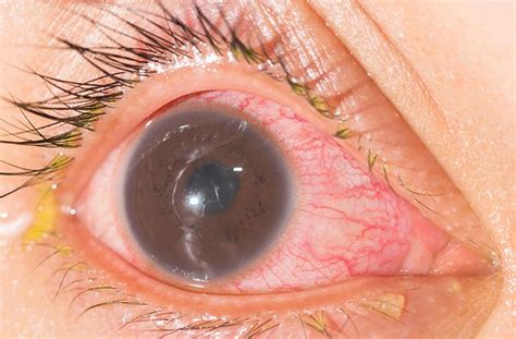 Iritis: Inflammation of the Iris