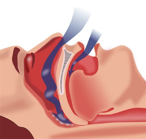 Sleep apnea - Wikipedia